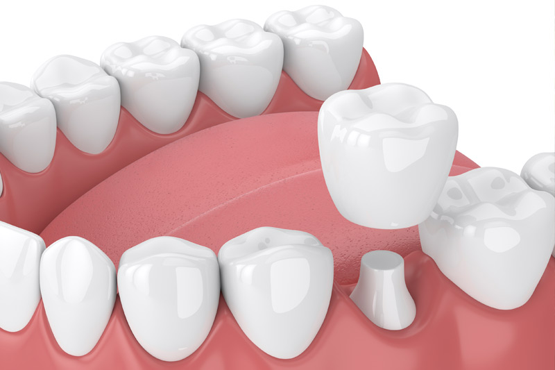 Dental Crowns in Cambridge