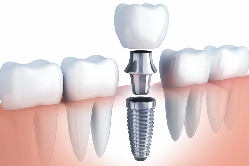 Dental Implants in Cambridge