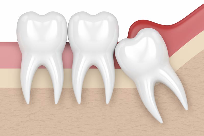Wisdom Tooth Removal in Cambridge